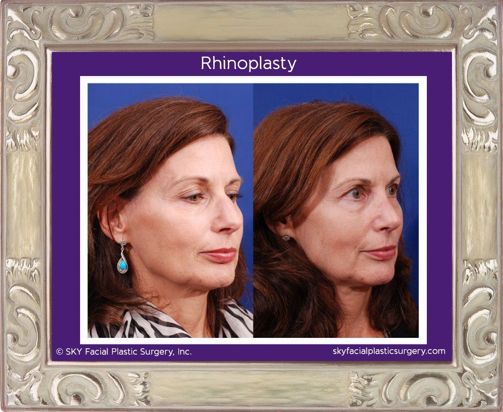 Rhinoplasty Before & After