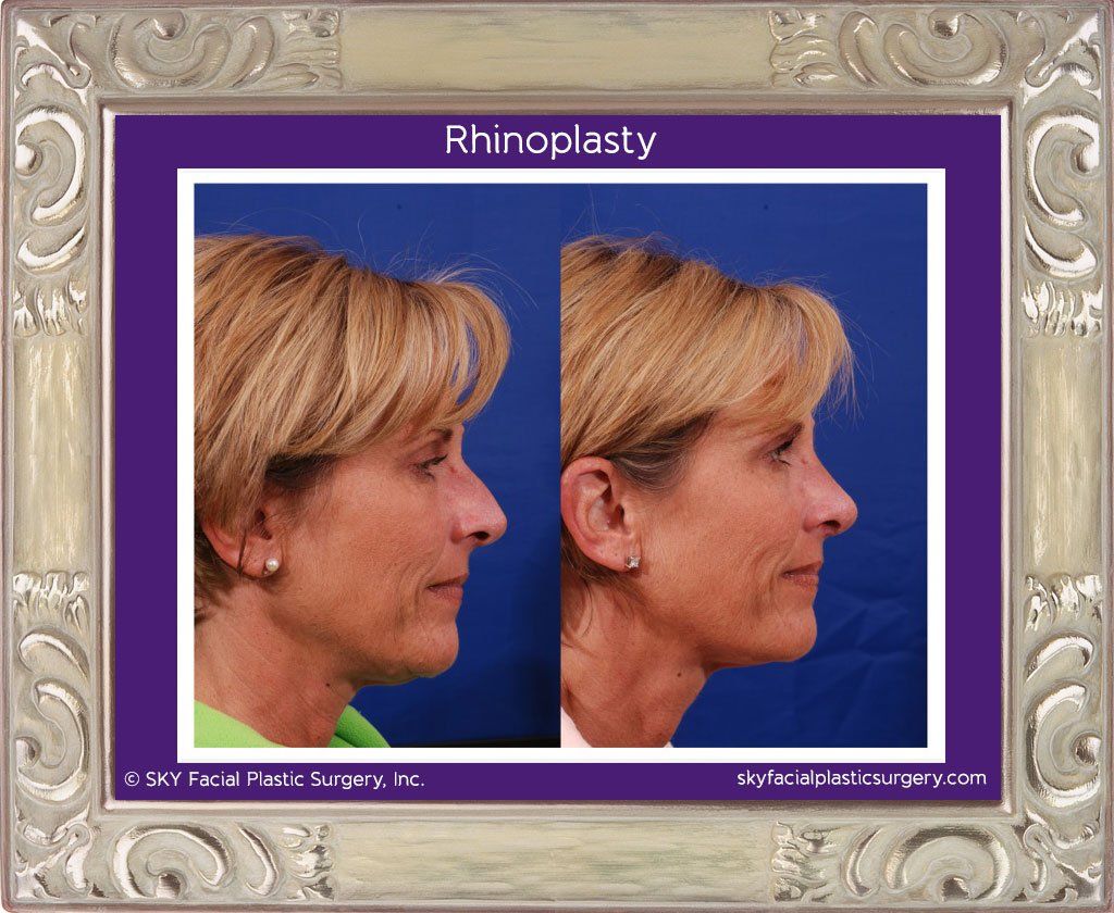 Rhinoplasty Before & After
