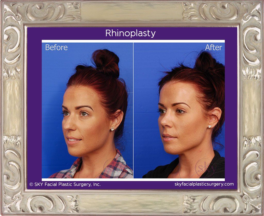 Rhinoplasty Before & After