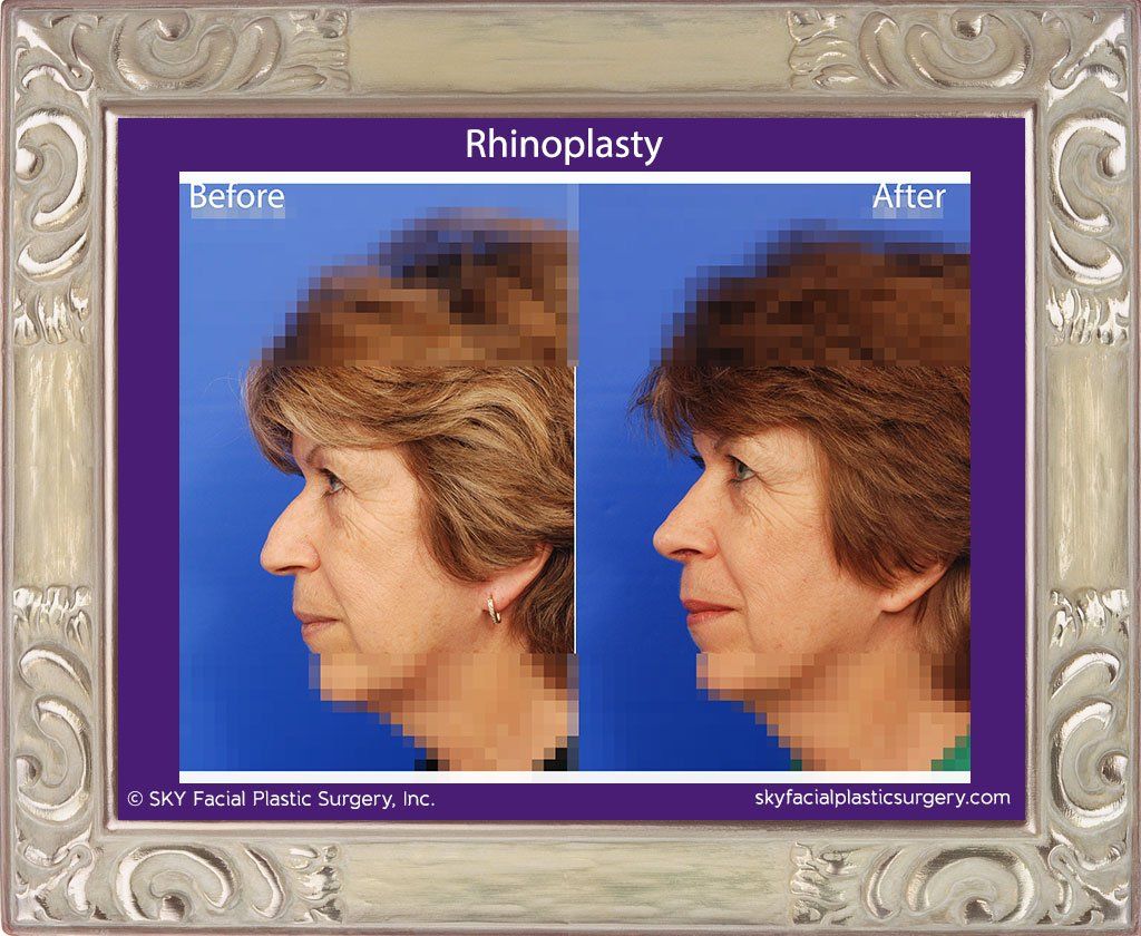 Rhinoplasty Before & After
