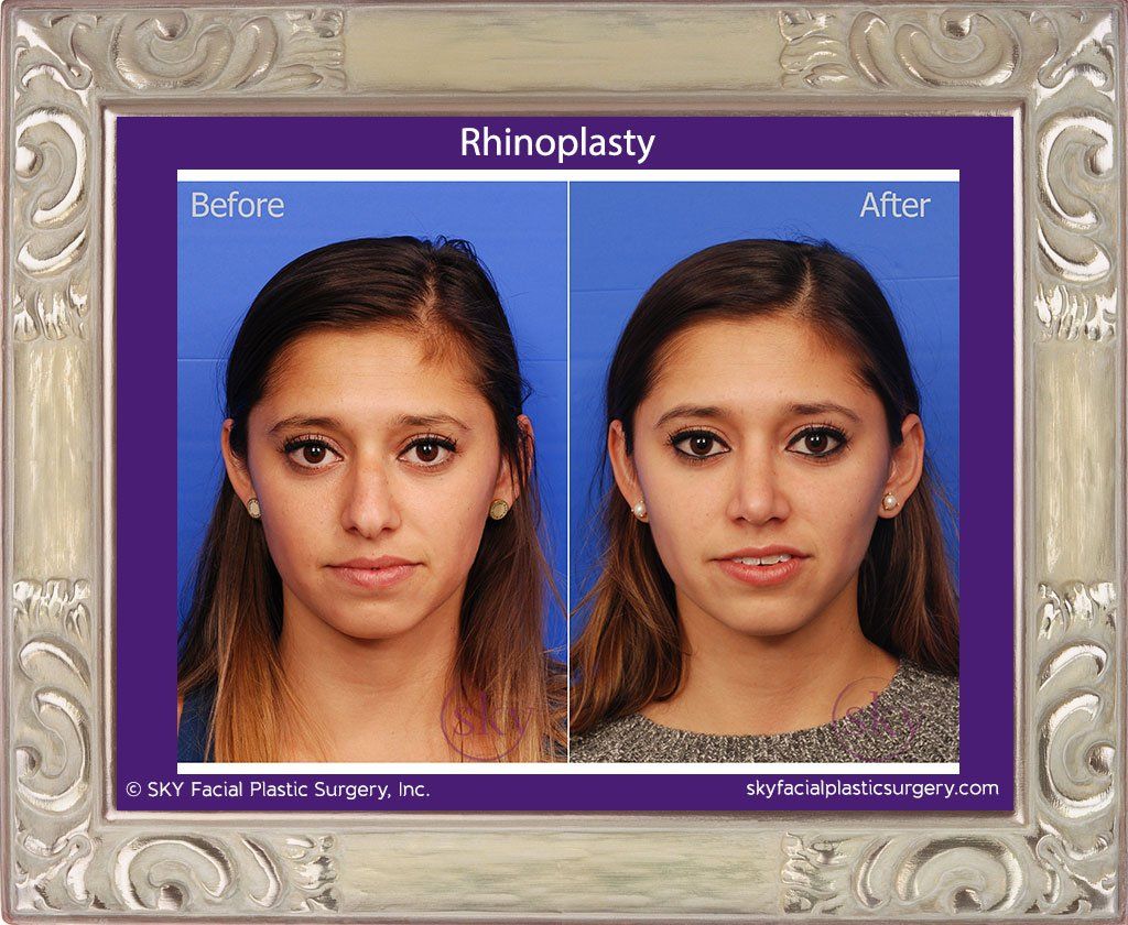 Rhinoplasty Before & After