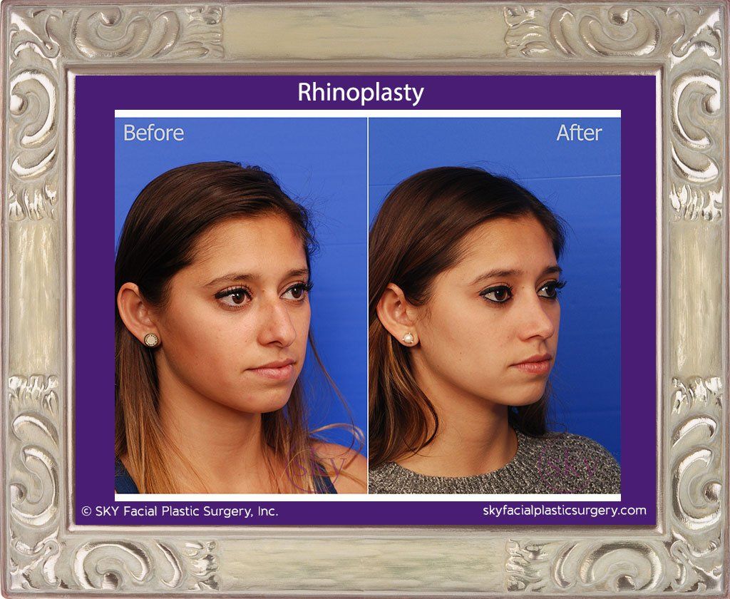 Rhinoplasty Before & After