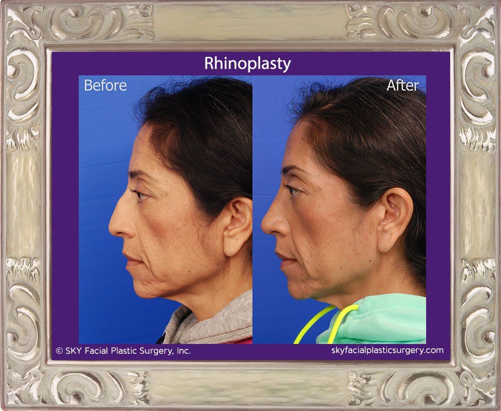 Rhinoplasty Before & After
