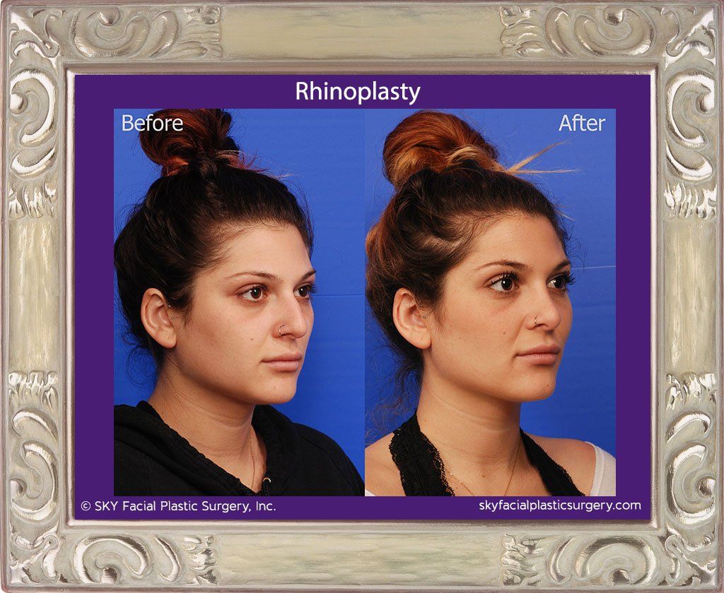 Rhinoplasty Before & After
