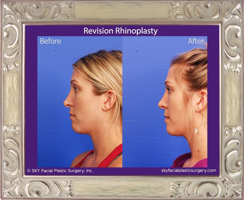 Rhinoplasty Before & After