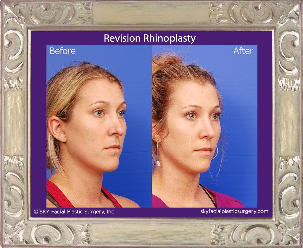 Rhinoplasty Before & After