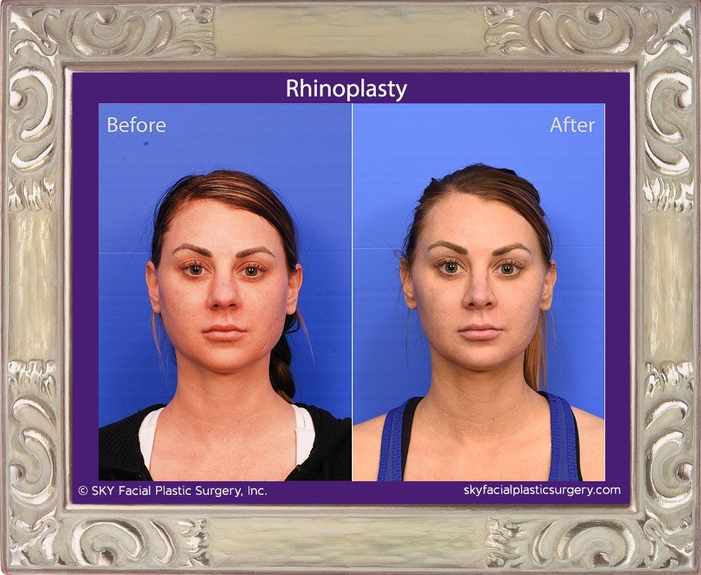Rhinoplasty Before & After