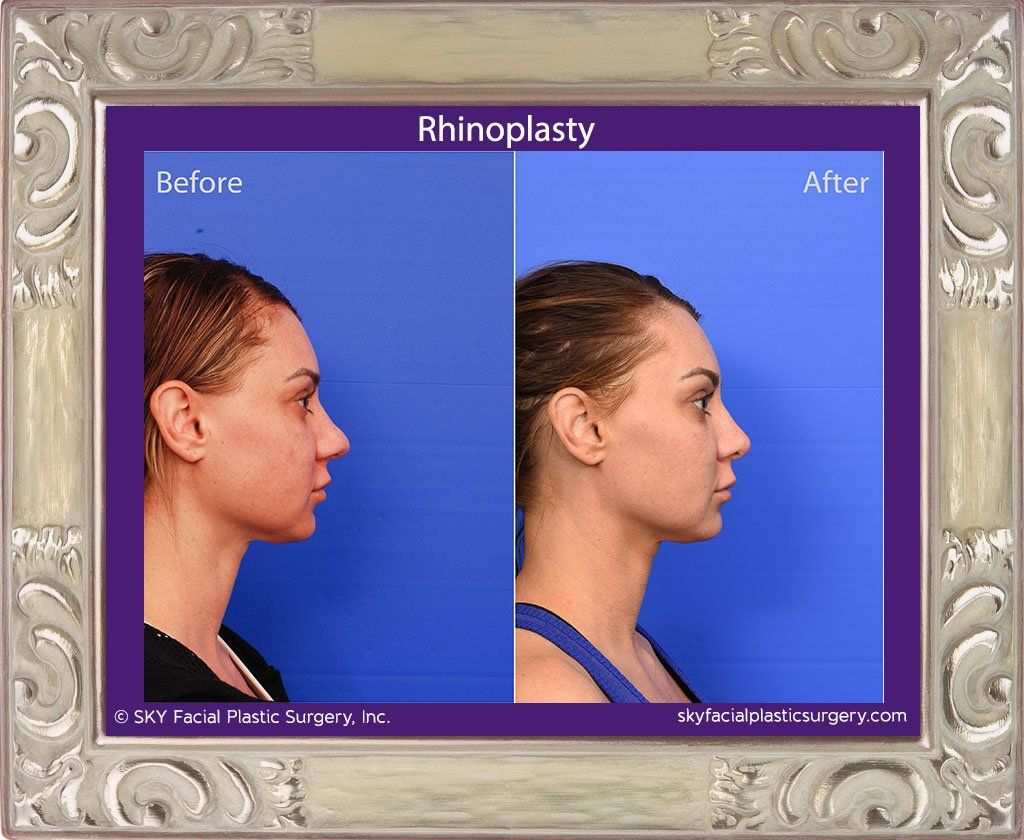 Rhinoplasty Before & After
