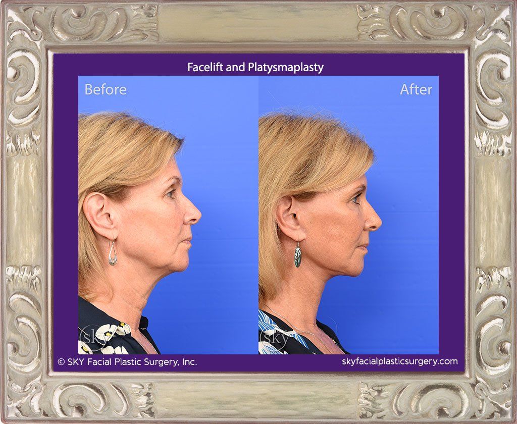Facelift Before & After