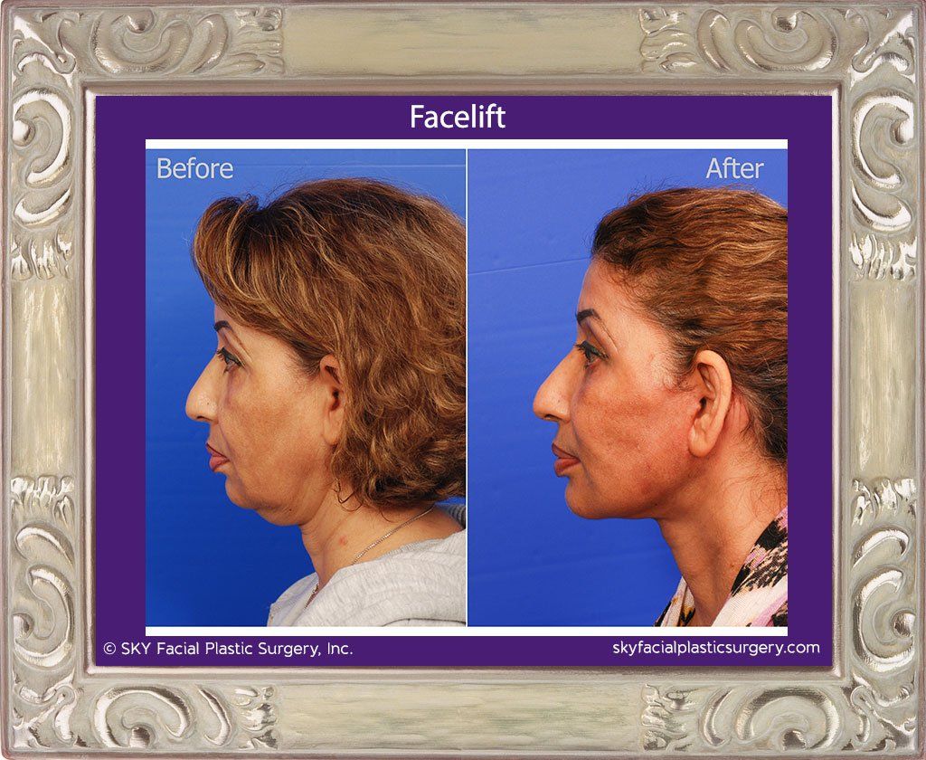 Facelift Before & After