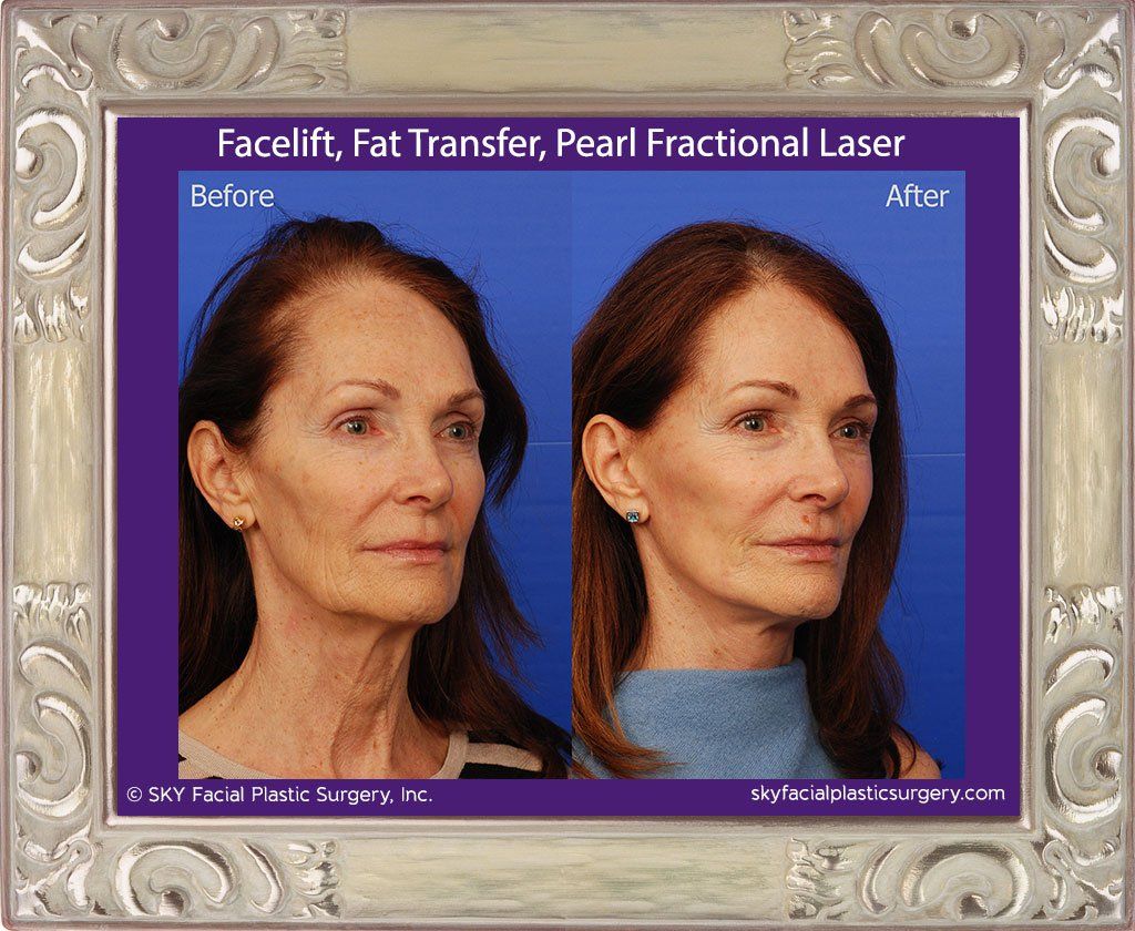 Facelift Before & After