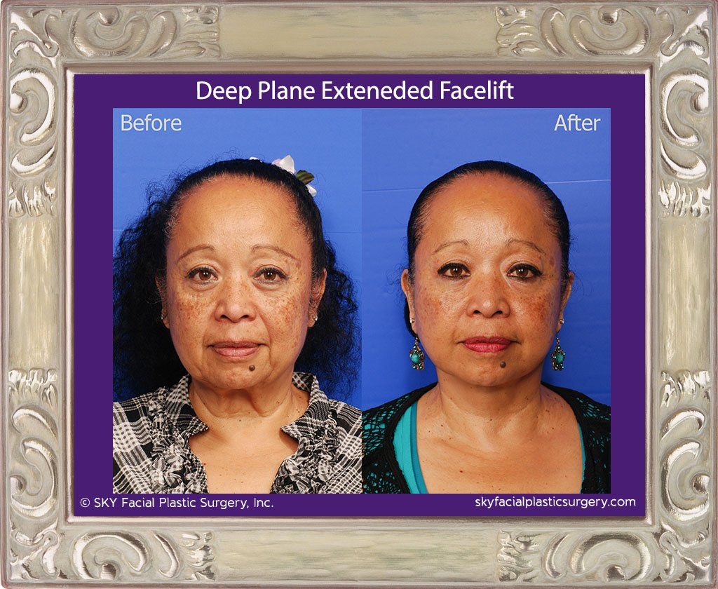 Facelift Before & After