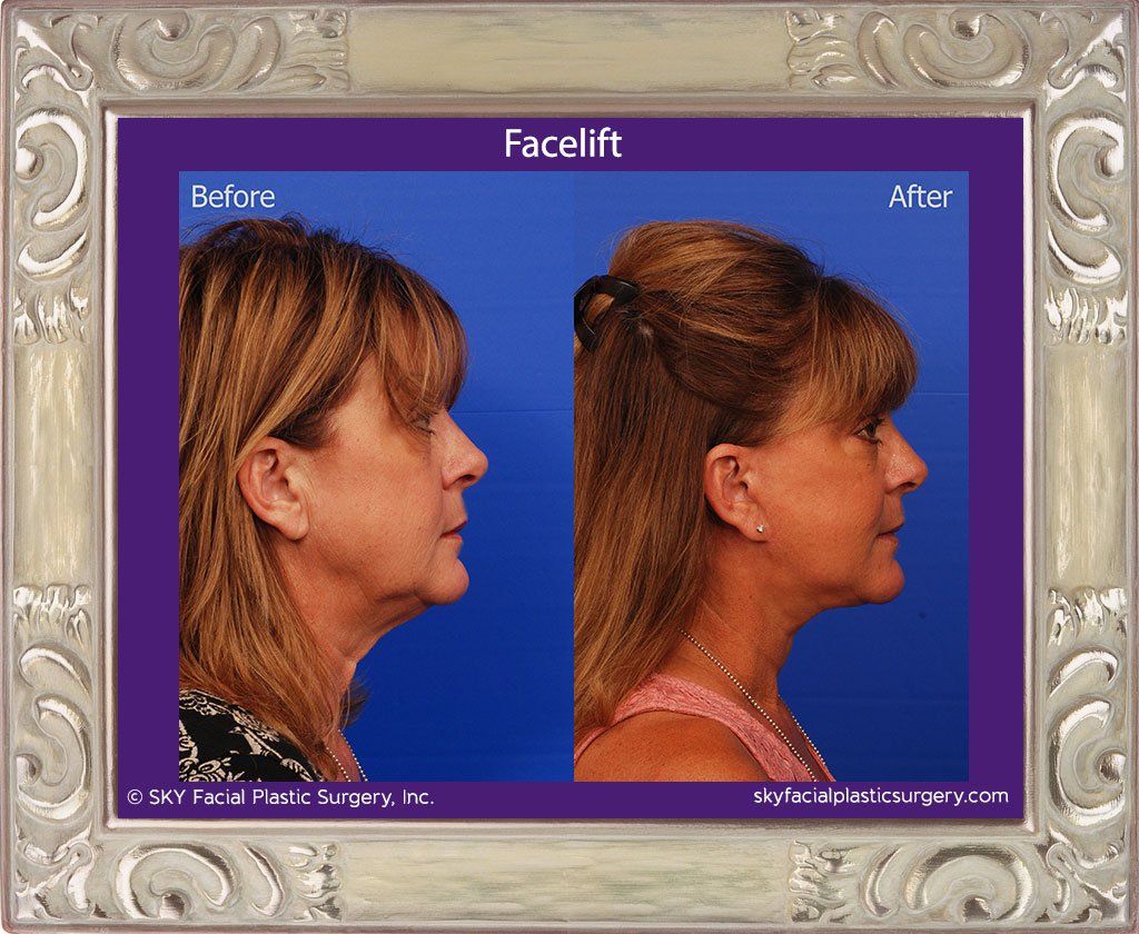 Facelift Before & After