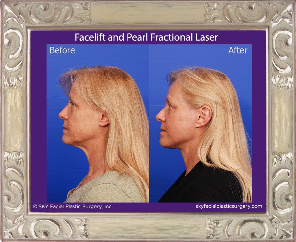 Facelift Before & After