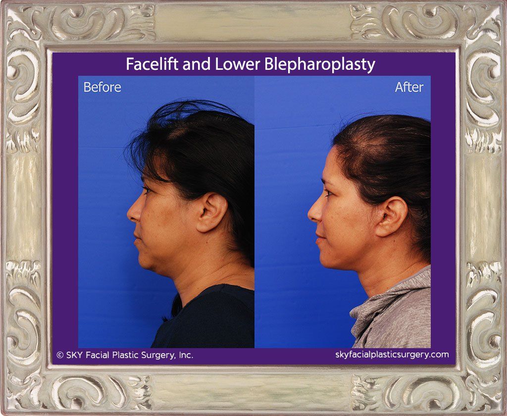 Facelift Before & After