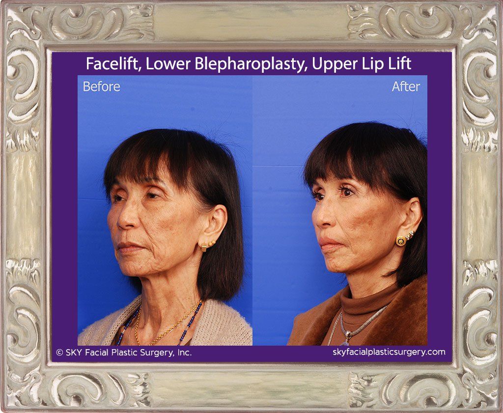 Facelift Before & After