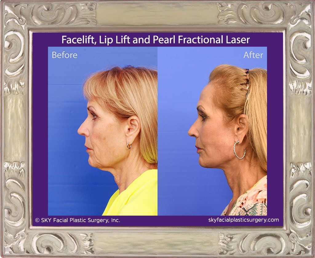 Facelift Before & After