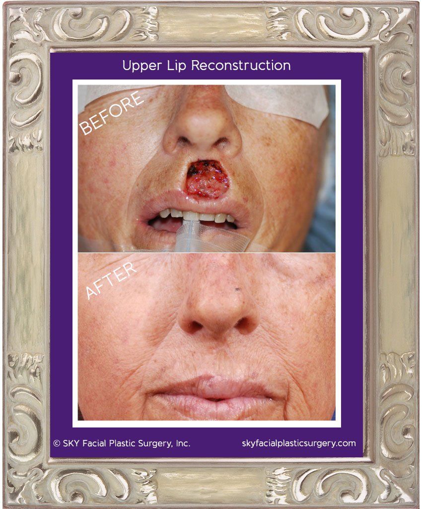 Mohs Reconstruction Before & After
