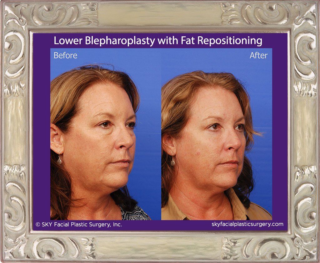 Blepharoplasty Before & After