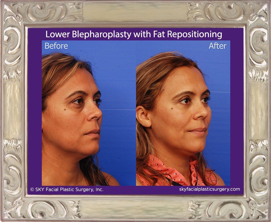 Blepharoplasty Before & After