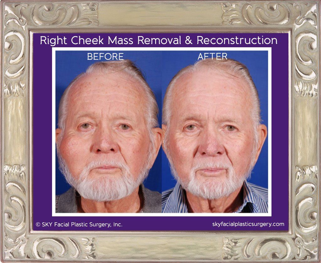 Reconstructive Surgery Before & After