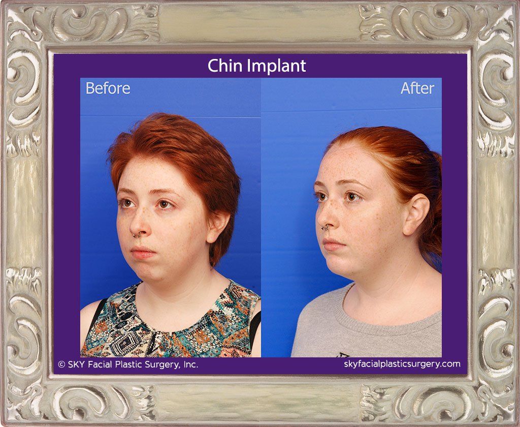 Chin Implant Before & After