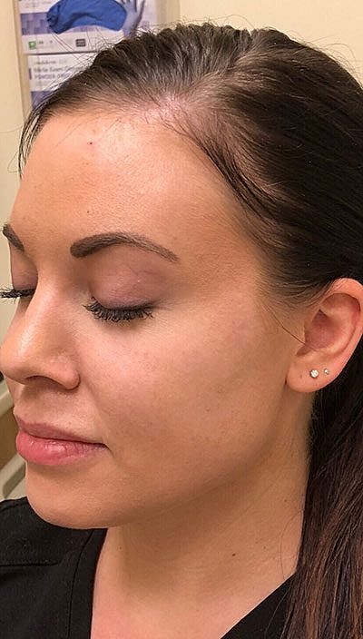 Cheek Filler Before & After