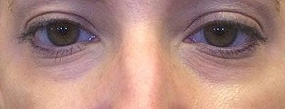 Fillers Before & After