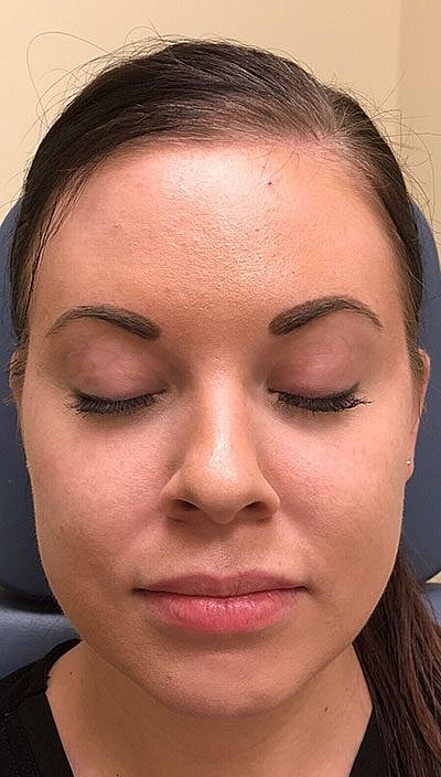 Lip Filler Before & After