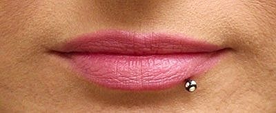 Lip Filler Before & After