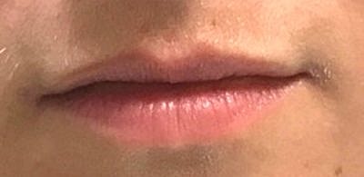 Lip Filler Before & After