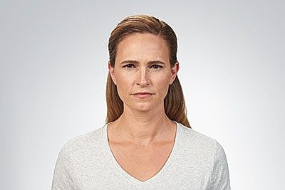 Botox Before & After