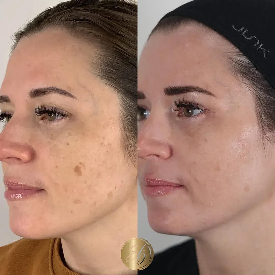 BBL Laser Before & After