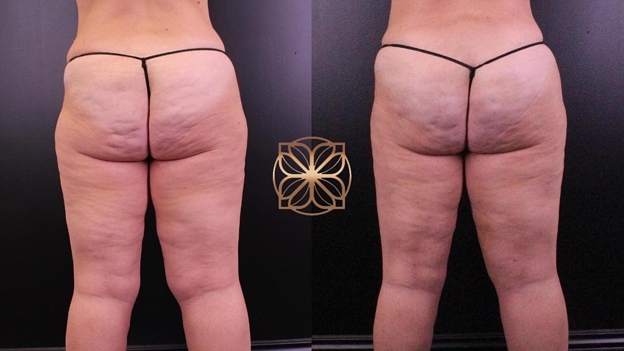 weight loss first month semaglutide Weight Loss Results after 4 weeks on Semaglutide weight loss first month semaglutide Weight Loss Results after 4 weeks on Semaglutide