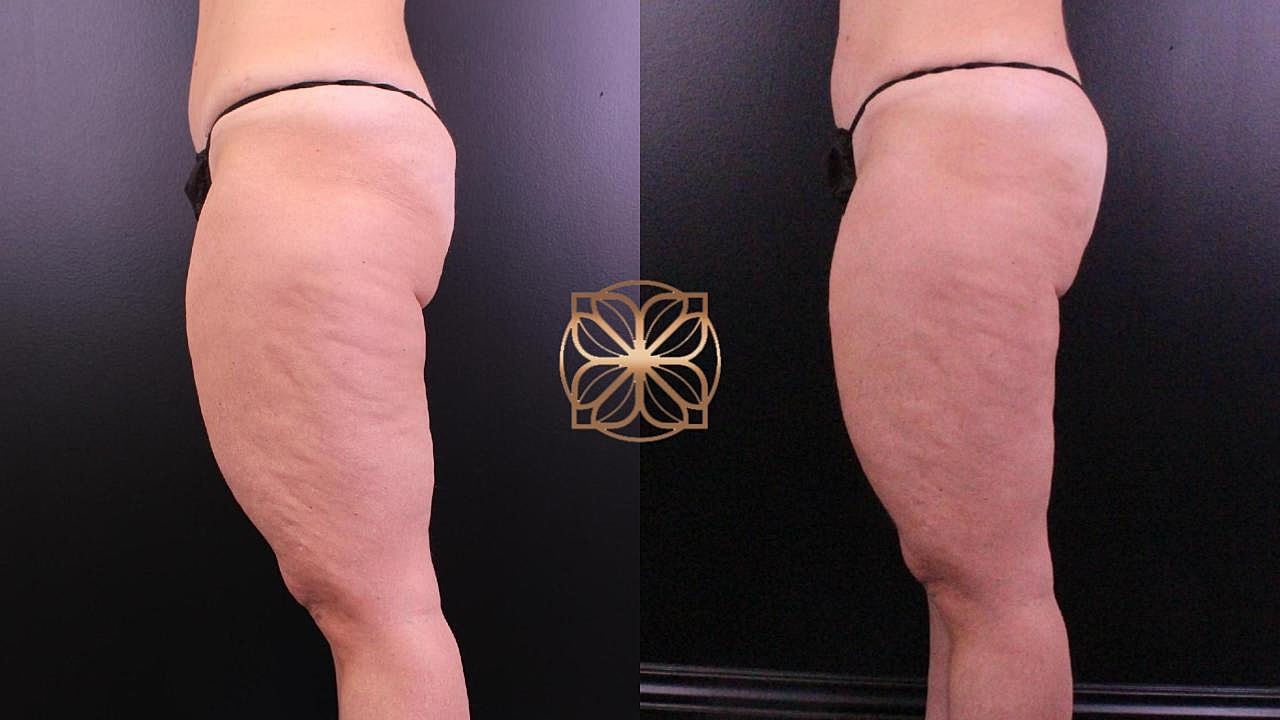 Weight Loss Program in Beverly Hills, CA | Spa26