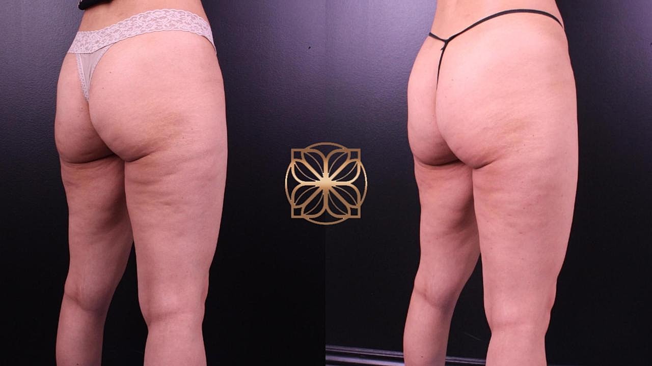 Weight Loss Program in Beverly Hills, CA