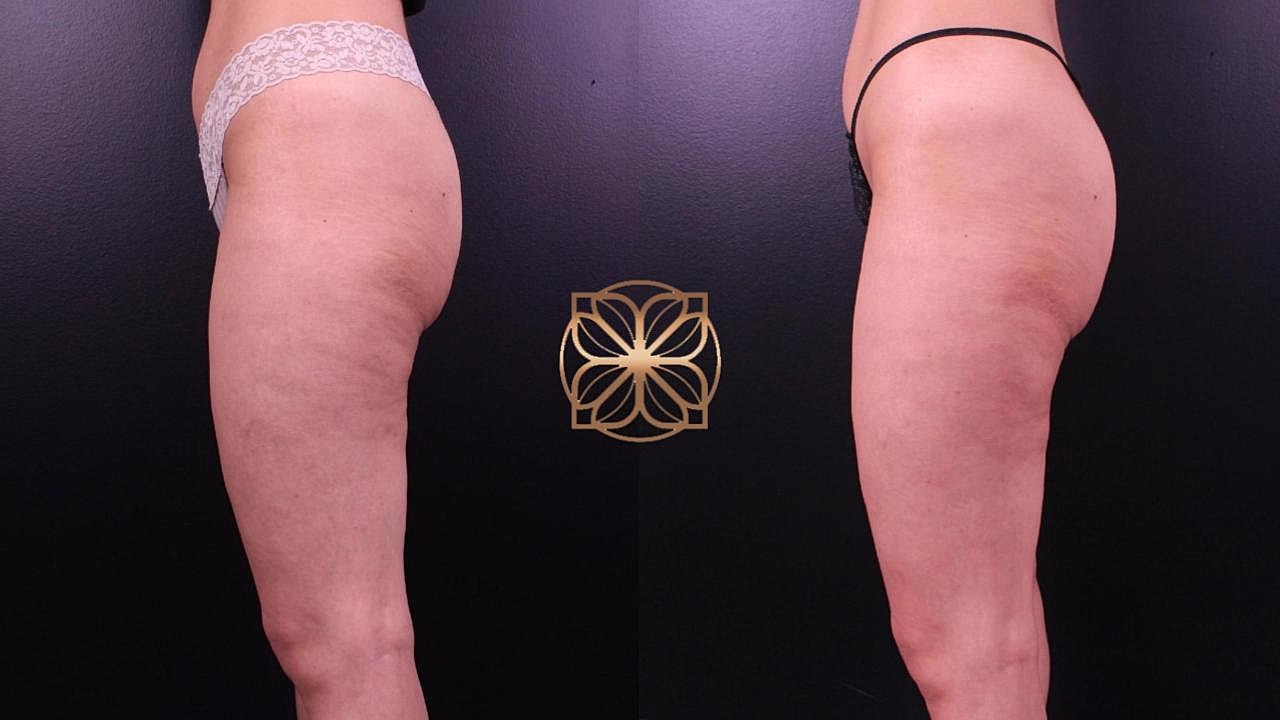Weight Loss Program in Beverly Hills, CA | Spa26 Weight Loss Program in Beverly Hills, CA | Spa26