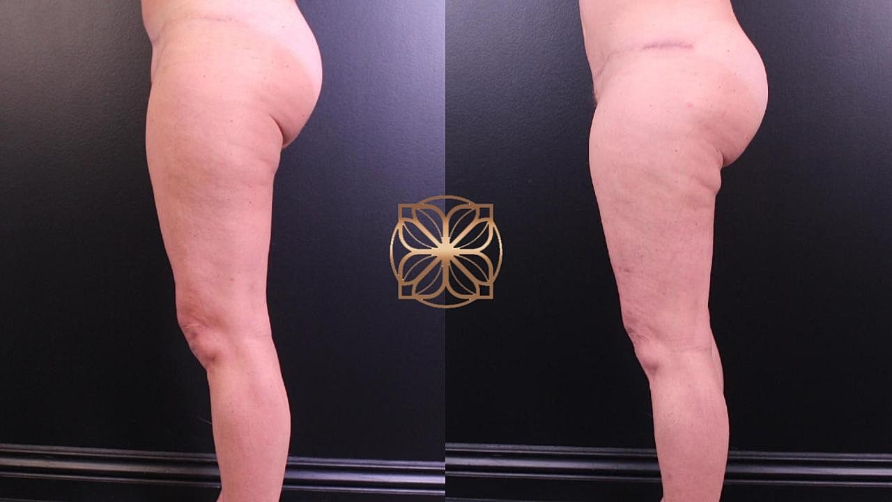 Weight Loss Program in Beverly Hills, CA | Spa26