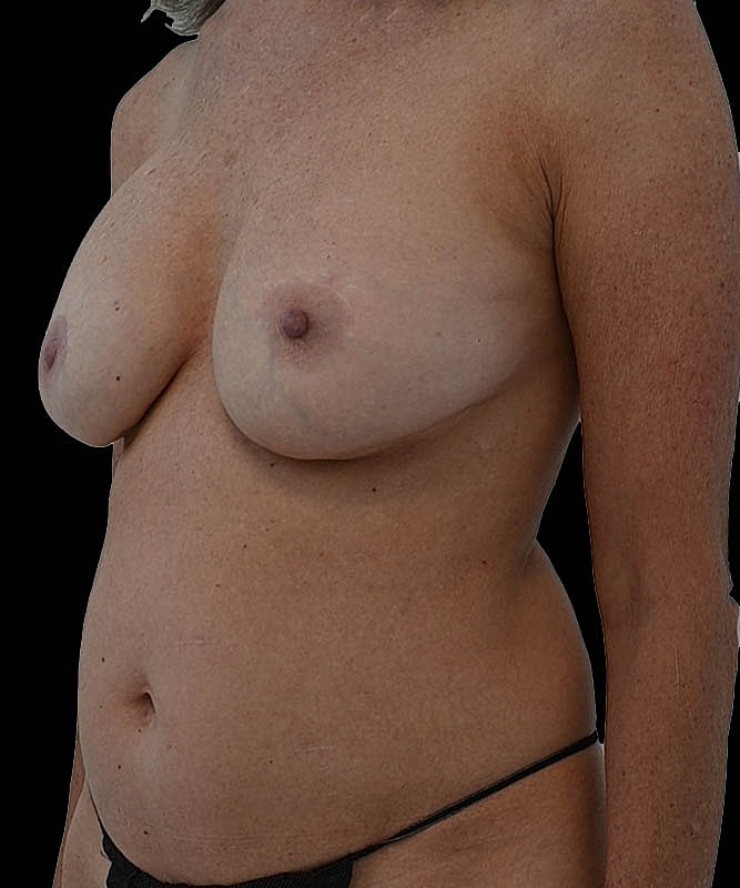 Cosmetic Flap Augmentation Before & After