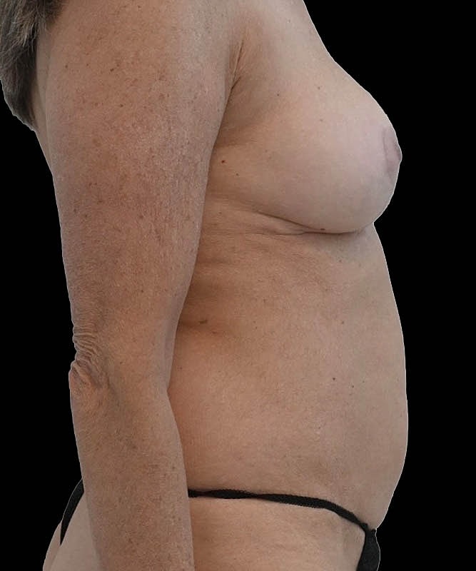 Cosmetic Flap Augmentation Before & After