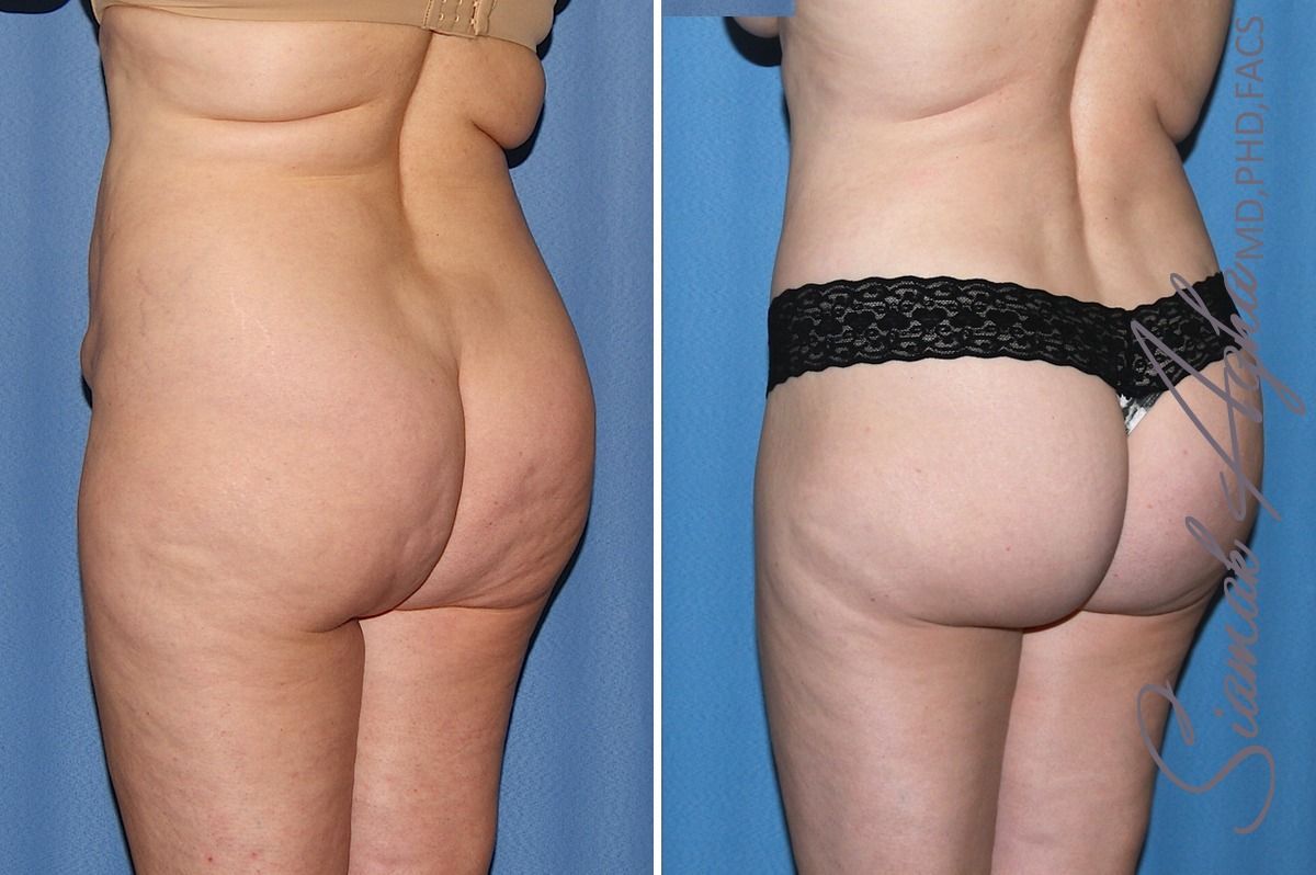 Combined Tummy Tuck Brazilian Butt Lift Before & After