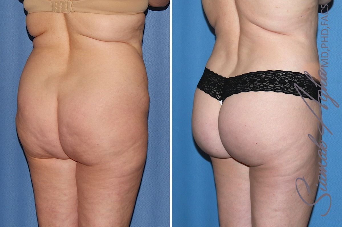 Combined Tummy Tuck Brazilian Butt Lift Before & After