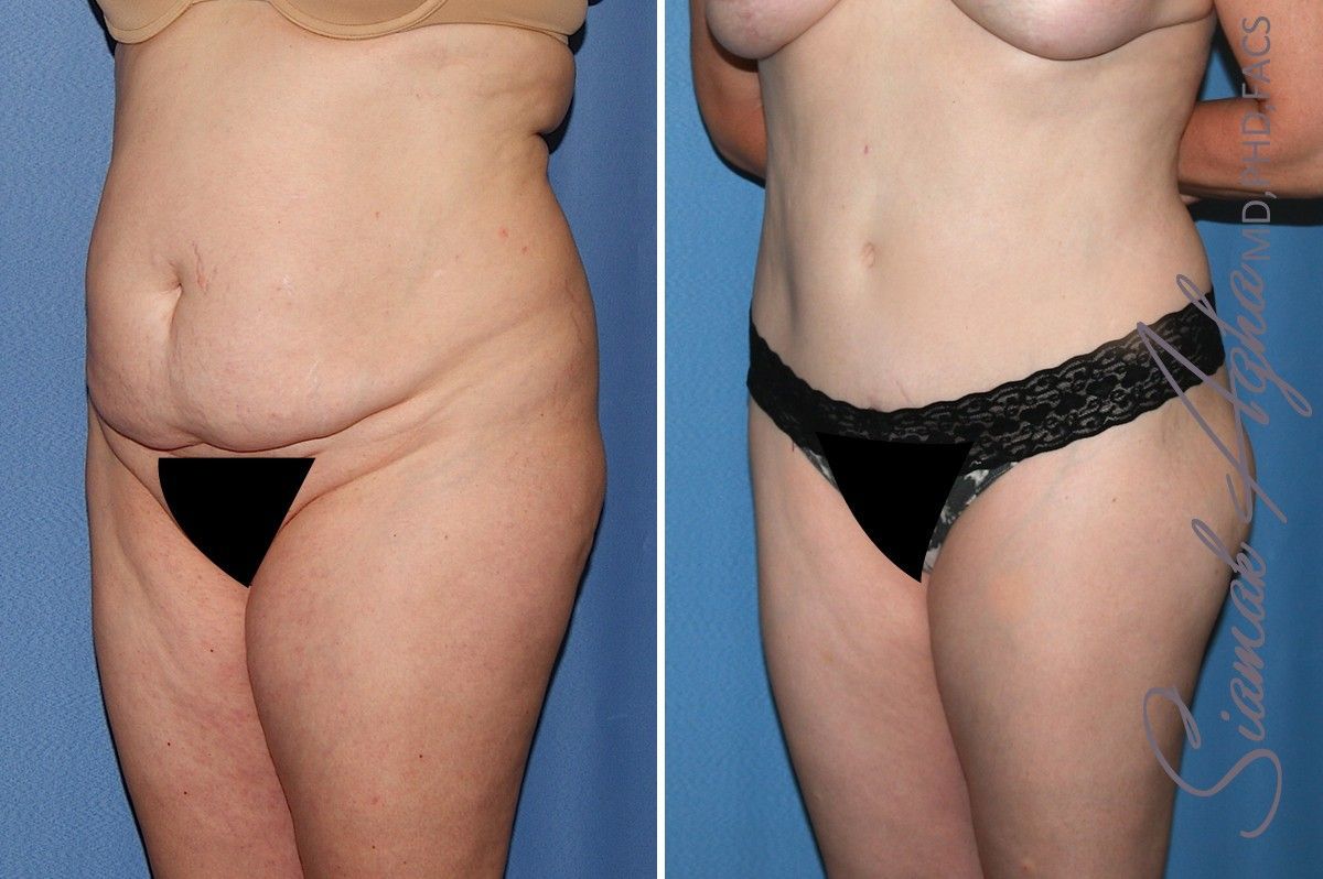 Combined Tummy Tuck Brazilian Butt Lift Before & After