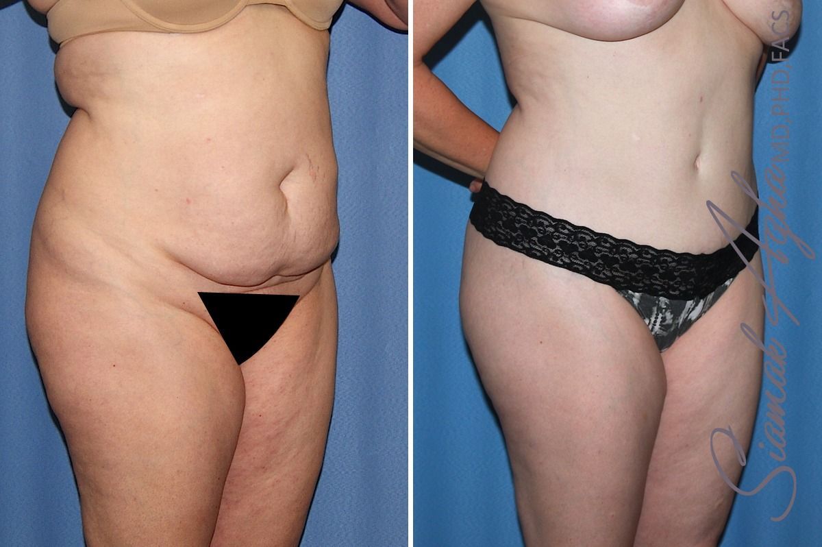 Combined Tummy Tuck Brazilian Butt Lift Before & After