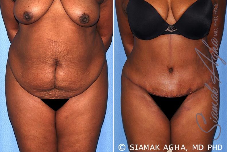 Tummy Tuck Before & After