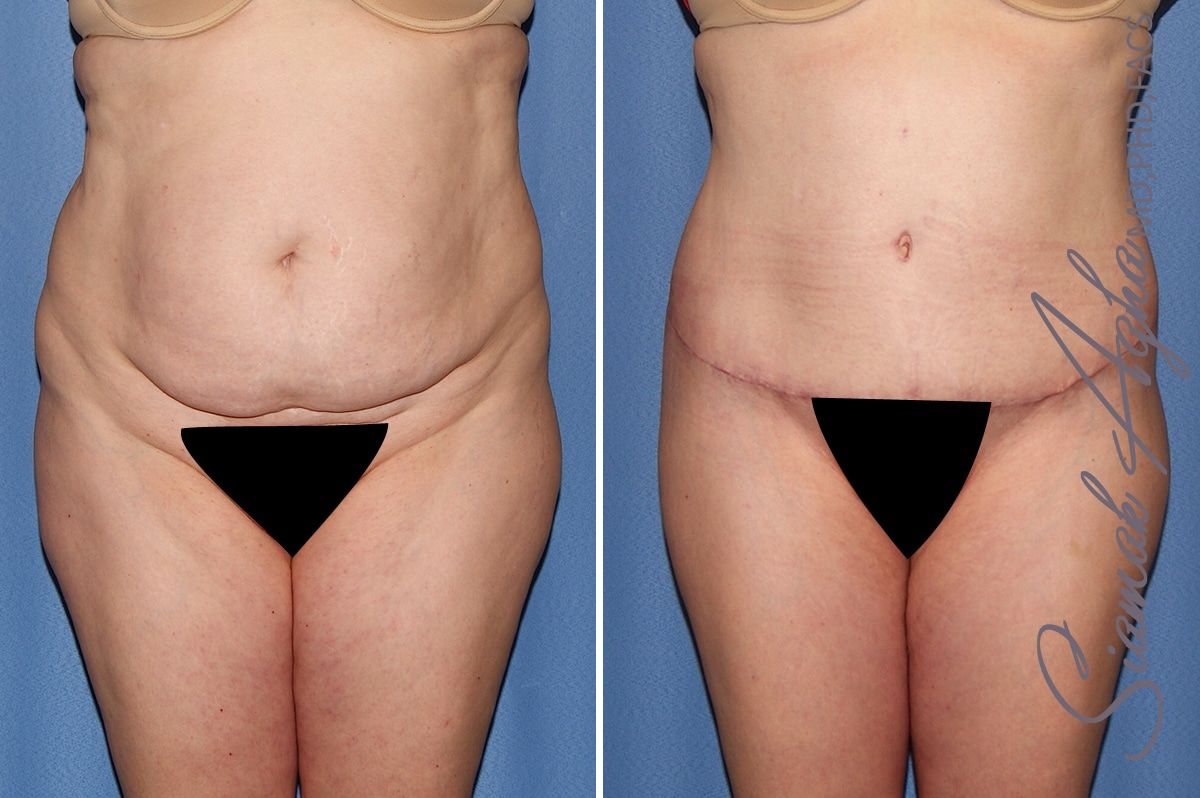 Tummy Tuck Before & After
