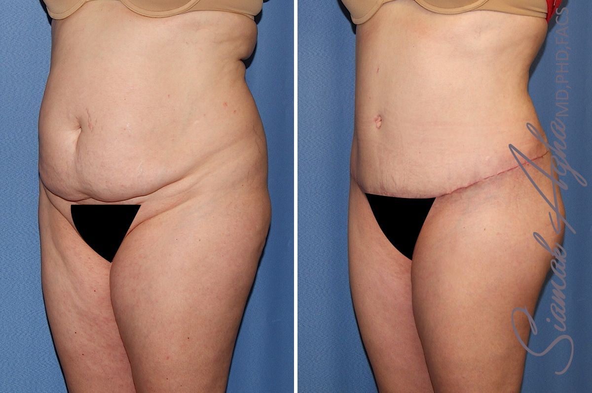Tummy Tuck Before & After