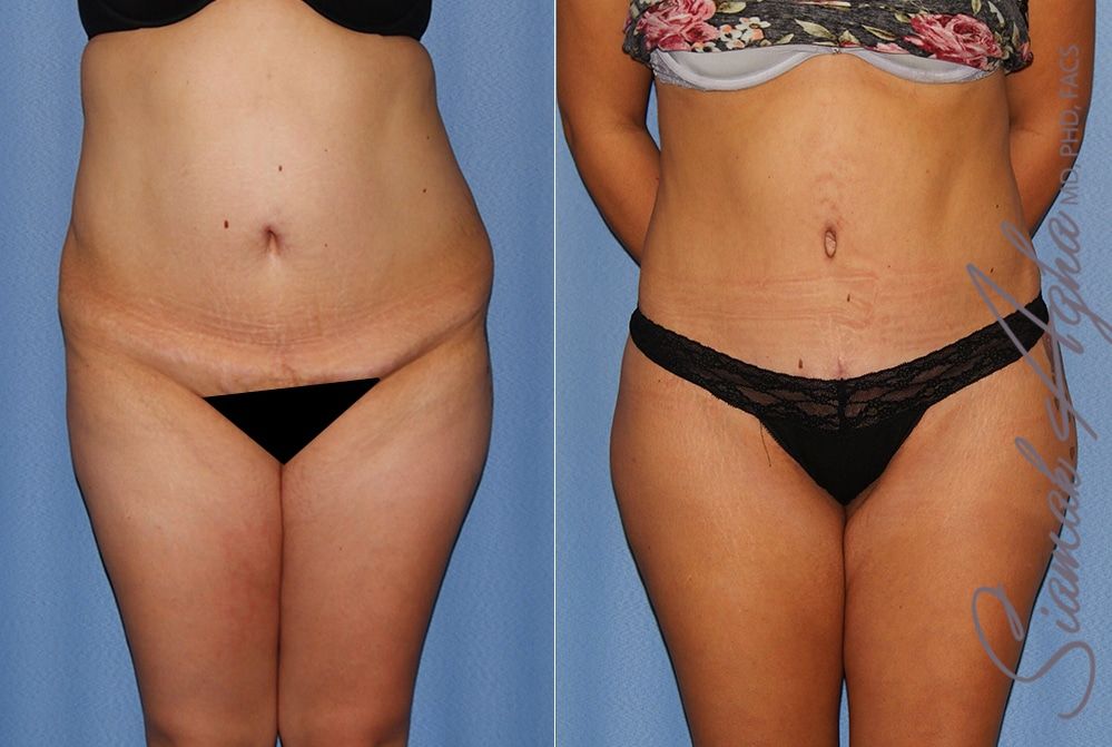 Tummy Tuck Before & After