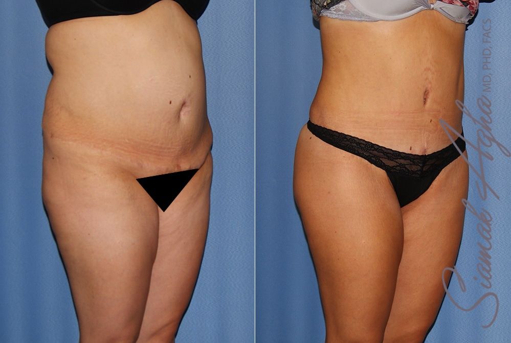 Tummy Tuck Before & After