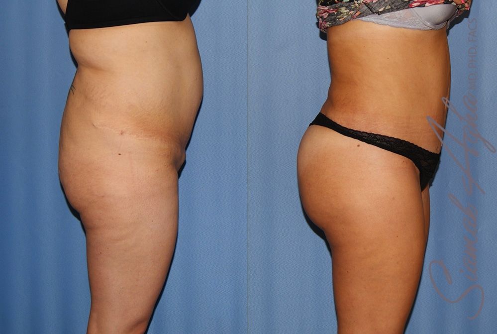 Tummy Tuck Before & After